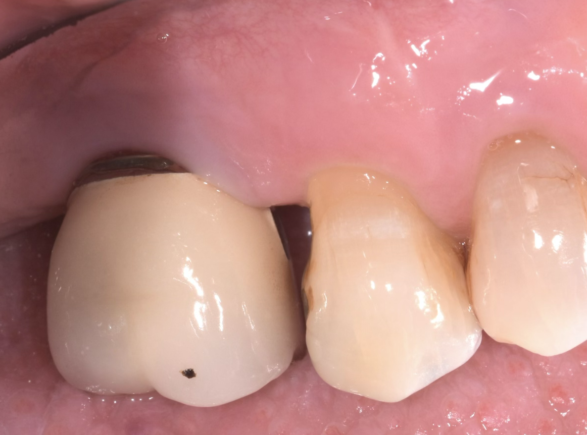 Treatment of Periimplantitis